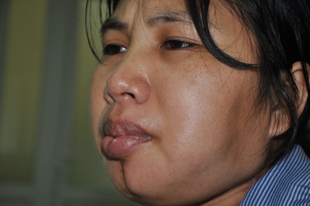 Hơn 80 triệu đồng đến với vợ chồng chị Vân bị ung thư - 1 Chị Vân bị ung thư xương hàm nên đang theo điều trị tại bệnh viện K3 Tân Triều.