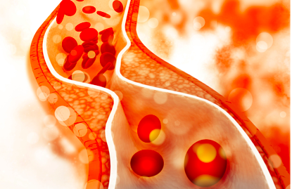 Vượt qua "cơn ác mộng" mang tên tim mạch - 3
Cholesterol LDL là “hung thủ” thật sự gây ra các vấn đề về bệnh tim mạch