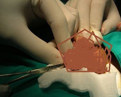 Hai bé trai bỗng bị hoại tử tinh hoàn - 2 Các bác sĩ đang phẫu thuật cắt bỏ tinh hoàn cho bé