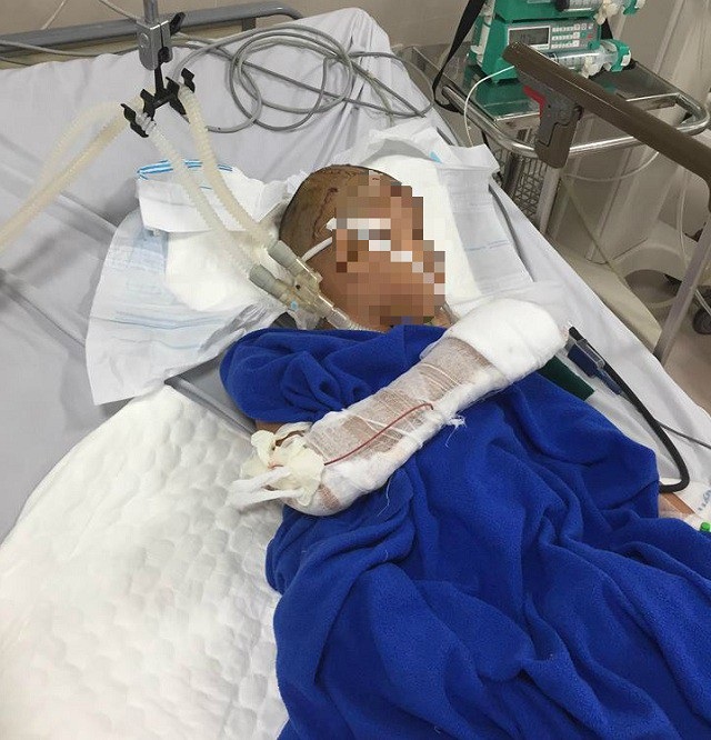 Bé trai 9 tuổi bị đối tượng nghi ngáo đá chém liên tục vào đầu - 1
Cháu L. đang điều trị tại Bệnh viện Hữu nghị Việt Nam - Cu Ba Đồng Hới. (Ảnh T.A.Đ)