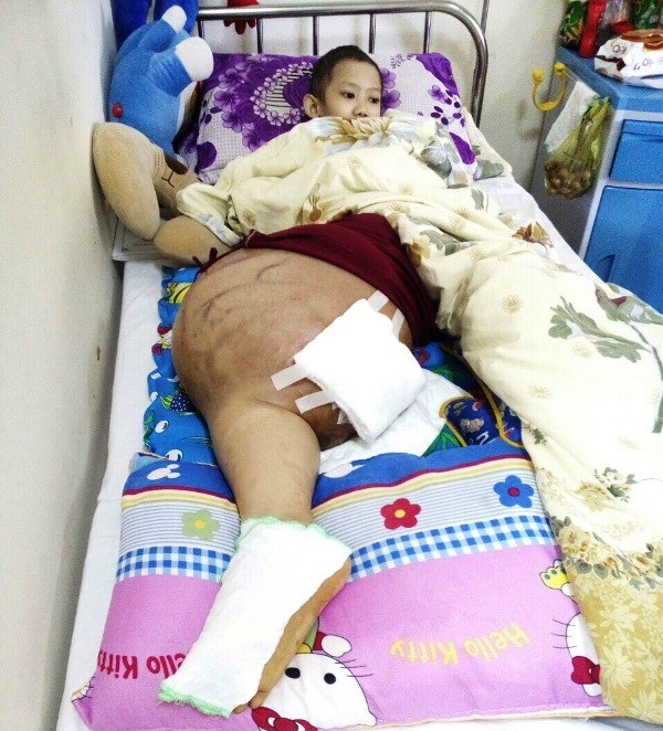 Sự sống mong manh của cậu bé mang chân phình to như… cột nhà - 1 Bệnh tật hành hạ khiến cháu An chịu nhiều đau đớn