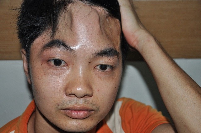 Bị chiếc ô tô đâm phải rồi bỏ trốn, Hùng may mắn thoát chết nhưng phần xương sọ của em bị khuyết nhiều tháng nay.