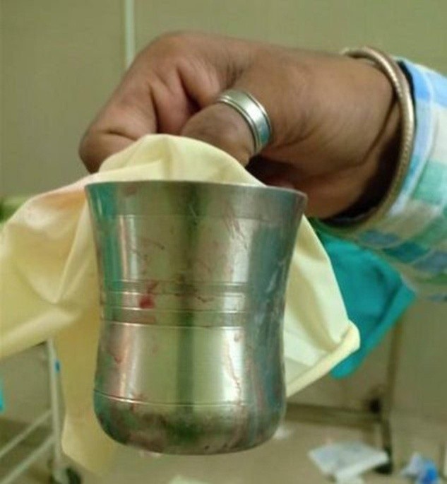 Giải cứu người đàn ông khốn khổ sau 10 ngày bị nhét cốc vào hậu môn - 1 Bác sĩ cầm cốc kim loại vừa lấy ra từ trực tràng của người đàn ông