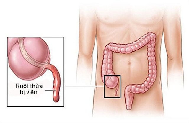 Căn bệnh khiến Hoa hậu Jennifer Phạm phải nhập viện gấp nguy hiểm thế nào? - 3 Vị trí ruột thừa trong hệ tiêu hóa (Ảnh minh họa)