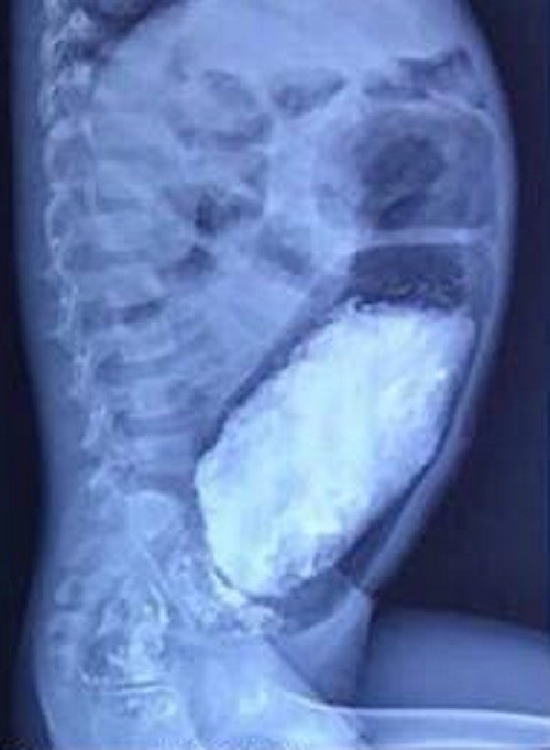 Bụng bệnh nhi phình căng, ruột chứa nhiều phân (phần màu trắng)