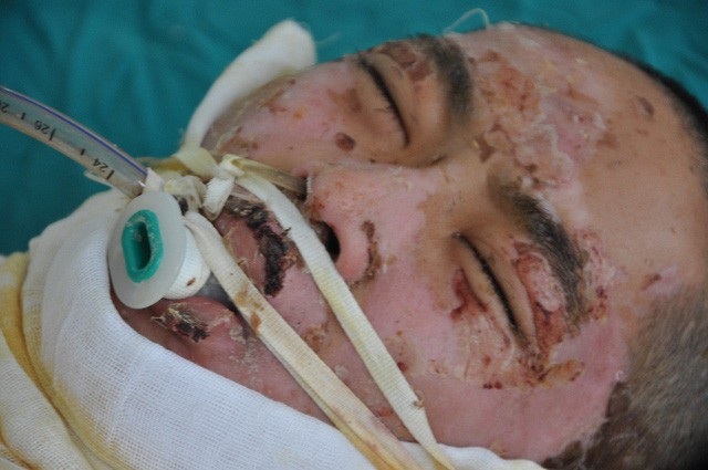 Quân đã mãi mãi ra đi sau tai nạn bỏng kinh hoàng.