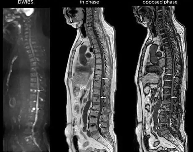 Phát hiện sớm bệnh lý mạch máu, ung thư, bệnh xương khớp… nhờ cộng hưởng từ - 2
Hình ảnh chụp cộng hưởng từ trong tầm soát di căn cột sống