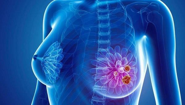 Ung thư vú là một trong những bệnh nguy hiểm mà phụ nữ ngoài 30 tuổi cần cảnh giác