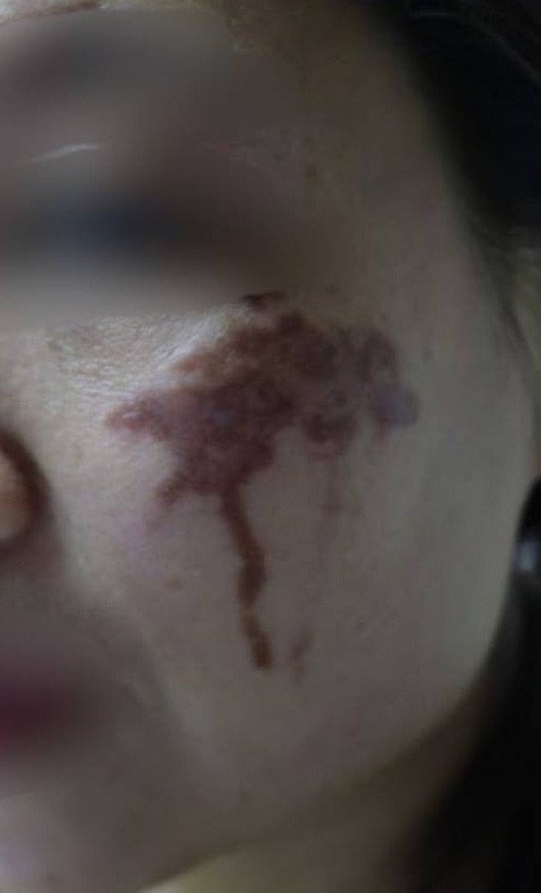 Hai má loang lổ, thâm tím vì chữa nám bằng axit tại spa - 1 Hai má loang lổ, thâm tím vì chữa nám bằng axit tại spa - 1