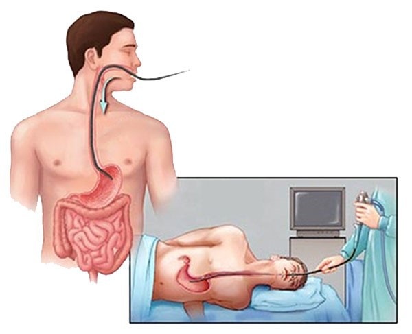 Muốn phát hiện sớm ung thư đường tiêu hóa, cần làm các xét nghiệm gì? - 2 Muốn phát hiện sớm ung thư đường tiêu hóa, cần làm các xét nghiệm gì? - 2