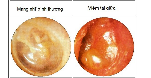 Bác sĩ chuyên khoa chỉ cách phân biệt dấu hiệu bệnh Tai - Mũi - Họng - 2 Bệnh lý viêm tai giữa