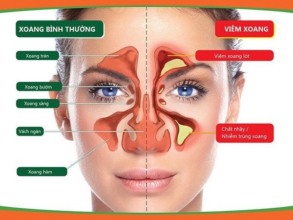 Bác sĩ chuyên khoa chỉ cách phân biệt dấu hiệu bệnh Tai - Mũi - Họng - 3 Đau nhức vùng mặt do viêm xoang