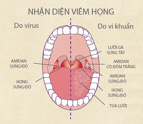 Bác sĩ chuyên khoa chỉ cách phân biệt dấu hiệu bệnh Tai - Mũi - Họng - 4 Nhận diện bệnh lý về viêm họng