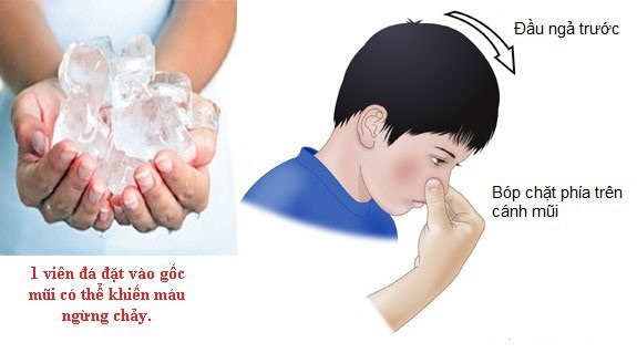 Ngày hè nắng nóng, chảy máu cam ở trẻ nhỏ có thể dẫn tới tử vong - 2 Sơ cứu đúng cách khi trẻ bị chảy máu cam