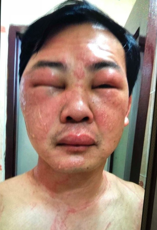 Sứa khổng lồ tấn công, du khách chằng chịt vết thương trên lưng như roi đánh - 1 Khuôn mặt bệnh nhân sưng vù sau ít phút bị sứa đốt.