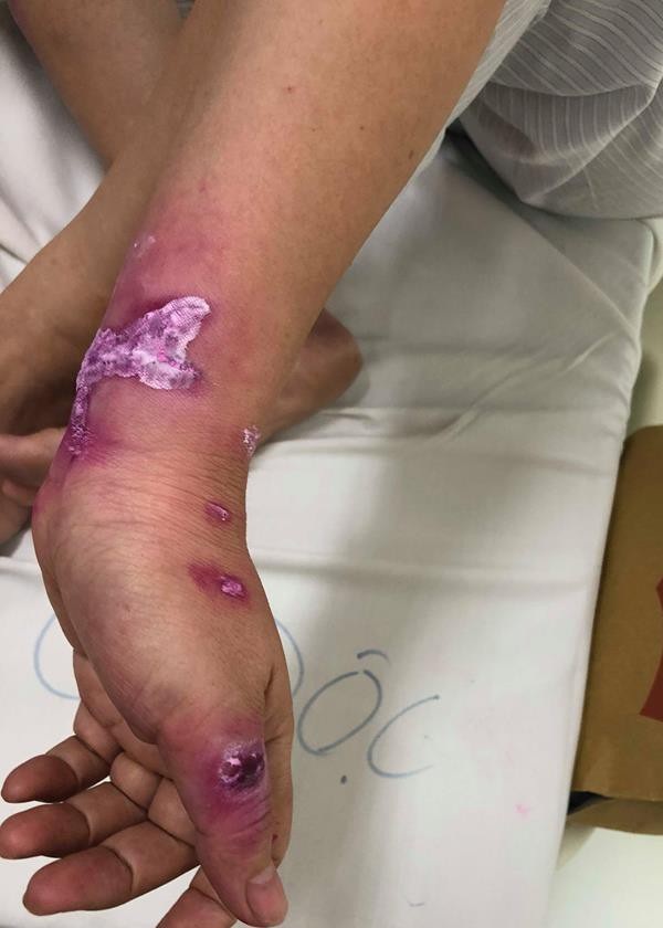 Sứa khổng lồ tấn công, du khách chằng chịt vết thương trên lưng như roi đánh - 3 Bệnh nhân bị tổn thương sâu, hiện đang có nhiễm trùng do dùng chanh chà sát mạnh vào vùng bị sứa đốt. Ảnh: H.Hải