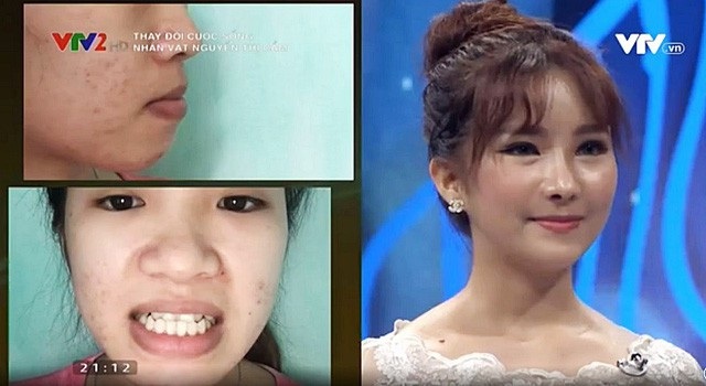 Cô gái nghèo bị khiếm khuyết lột xác thành “búp bê” khiến Đan Lê sửng sốt - 1 Nguyễn Thị Cẩm trước và sau khi đã tiến hành phẫu thuật thẩm mỹ.