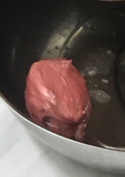 (CHUYỆN KHÓ TIN) 12 giờ "giải cứu" cục ma túy giấu trong vùng kín - 1