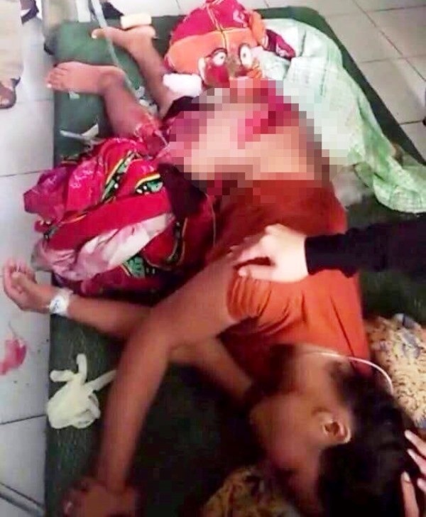 
Chị T. bị thương nặng do bị cánh quạt thuyền chém phải trong lúc cứu con trai.
