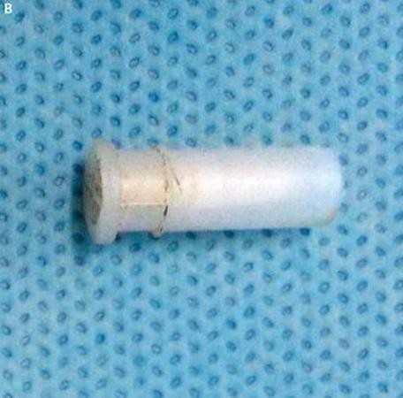 Thở ra tiếng sáo, ai dè cậu bé mắc kẹt còi trong cổ họng - 2 Chiếc còi nhỏ đã bị kẹt trong đường hô hấp của bé trai