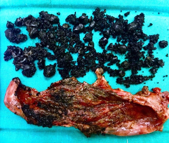 Ca viêm túi mật trước nguy cơ hoại tử đã được phẩu thuật thành công.