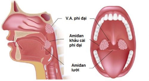 Có nên cắt amiđan không? - 1 Nếu amiđan thường xuyên bị nhiễm trùng, chúng có thể lợi bất cập hại