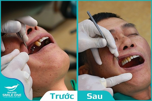 Cấy ghép Implant Surface Slactive 5D - Trọn vẹn một nụ cười! - 2 Bệnh nhân Thọ (49 tuổi) trước và sau khi cấy ghép Implant