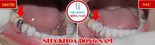Trồng răng Implant và những điều bạn cần lưu ý - 2 Bệnh nhân trồng răng Implant ở vị trí răng nhai tại Nha Khoa Đông Nam
