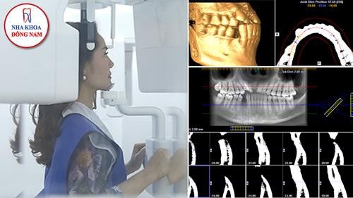 Trồng răng Implant và những điều bạn cần lưu ý - 3 Chụp CT3D ConeBeam để đánh giá mức độ tiêu/thiếu xương trước khi thực hiện