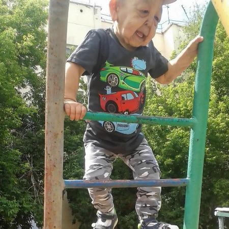 Em bé mới 6 tuổi trông đã như ông lão 60 - 4 Hội chứng Ehlers-Danlos có thể dẫn đến biến chứng như viêm xương khớp, vẹo cột sống