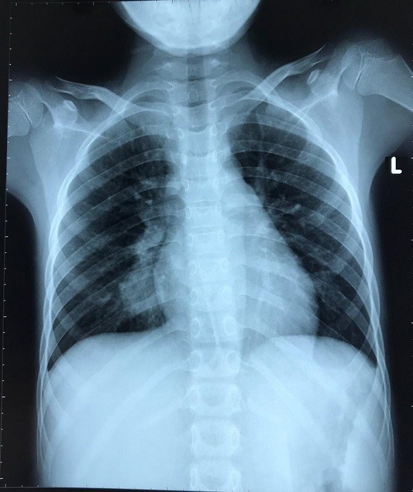 Bé trai ho ra máu vì mắc bệnh hiếm gặp - 1 Hình ảnh X-quang phổi bệnh nhi trước khi được can thiệp