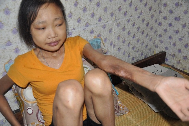 Hơn 65 triệu đồng đến với em Lan bi suy thận mãn - 1 2 con mất, chồng chia tay và đã có gia đình mới, bản thân Lan lại bệnh tật bủa vây.