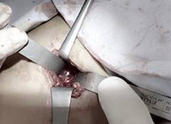 Bé trai nghịch súng bắn chim, đạn xuyên lưng nằm trong đĩa đệm - 2 Sau 1 giờ phẫu thuật, các bác sĩ đã gắp thành công viên đạn