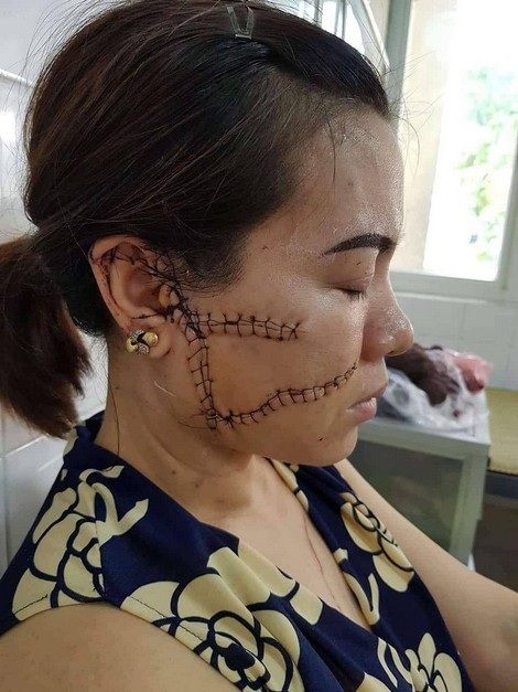Cuộc đời đầy bi kịch của người đàn bà - 2 Mặc dù đã qua cơn nguy kịch nhưng chị Oanh luôn nơm nớp lo sợ tiếp tục bị trả thù.