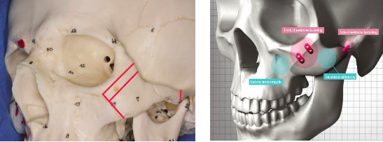 Thực hư về hạ gò má giúp trẻ ra chục tuổi - 1
Kĩ thuật cắt xương High- L Osteotomy