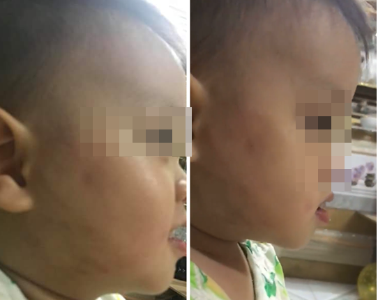 Phụ huynh “tố” vụ bé 20 tháng bị đánh ở lớp: Chủ tịch Hà Nội yêu cầu xác minh - 2 Hình ảnh bé trai 20 tháng bị thâm tím mặt