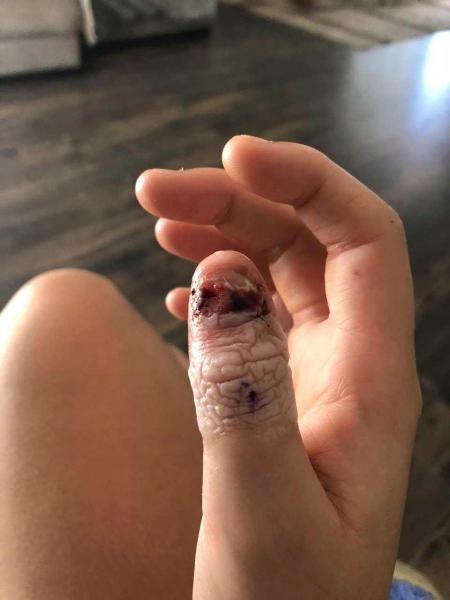 Cô gái 20 bị cắt cụt ngón tay vì thói quen cắn móng tưởng như vô hại - 3 ...nhưng rồi ngón tay cô bắt đầu chuyển sang màu đen