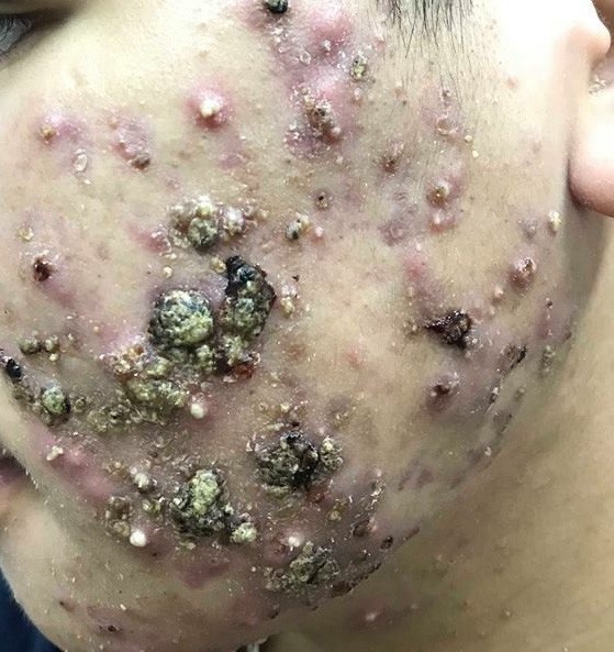 Hãi hùng những “gương mặt ma” vì kem trộn làm đẹp thần tốc - 2 Nam sinh nổi mặt mụn mủ chi chít sau một thời gian dùng kem trộn.