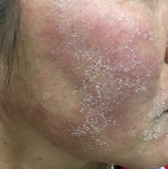 Hãi hùng những “gương mặt ma” vì kem trộn làm đẹp thần tốc - 3 Hãi hùng những “gương mặt ma” vì kem trộn làm đẹp thần tốc - 3