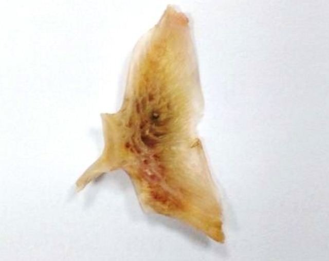 Đau rát vùng thực quản vì mắc nghẹn xương cá to - 1 Xương cá ngát được lấy ra từ thực quản bệnh nhân. (Ảnh: BV Thanh Vũ Bạc Liêu)
