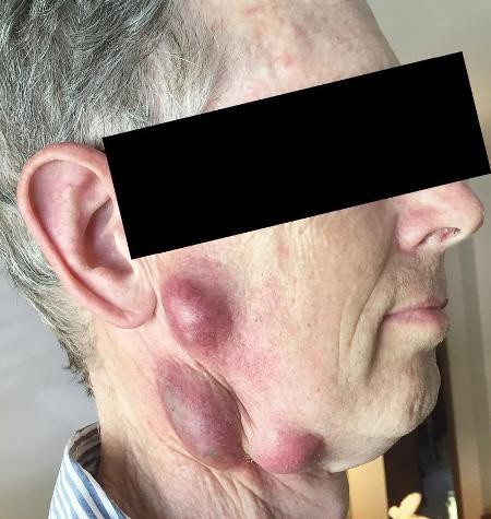 Lây bệnh lạ từ mèo, người đàn ông mọc u trên cổ và mặt - 1 Những khối u đáng sợ trên mặt và cổ bệnh nhân