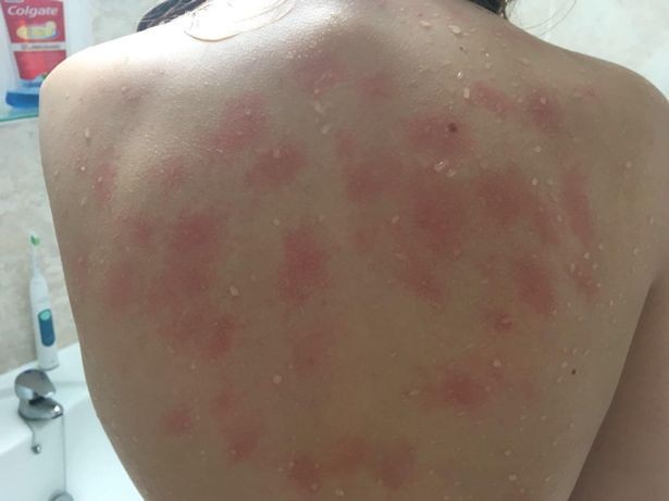 Căn bệnh siêu hiếm khiến cô gái trẻ dị ứng với cả nước mắt của chính mình - 2 Tắm rửa hay chảy nước mắt cũng khiến cô dị ứng