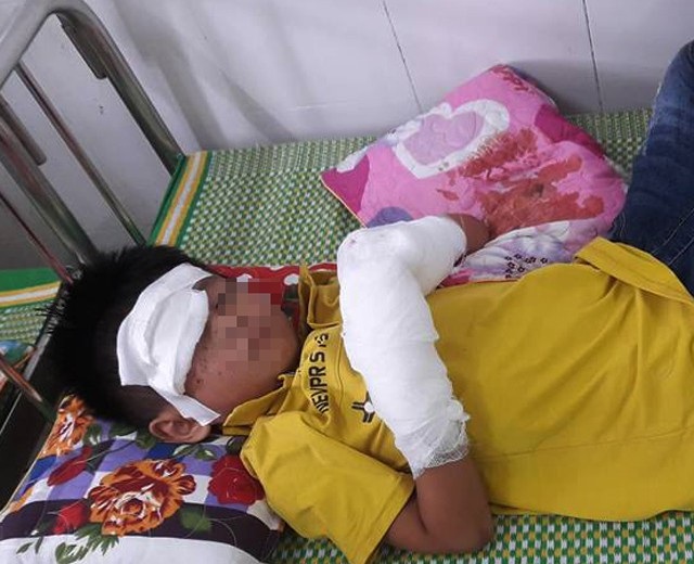 Sau tiếng nổ, bé trai 7 tuổi nát hai bàn tay - 1 Bệnh nhi T.X.H sau khi được sơ cứu, chuyển xuống Bệnh viện Sản Nhi Nghệ An với hai bàn tay dập nát và khuôn mặt bị tổn thương (ảnh N.Thương)