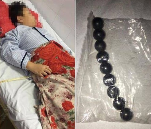 Sẽ làm rõ vụ việc nam sinh lớp 5 bị bạn học ép nuốt 9 viên bi sắt - 1 Ảnh trái: Em L. đang được điều trị tại bệnh viện, ảnh phải: 9 viên bi sắt được lấy ra từ ruột của em. (Ảnh: CTV)
