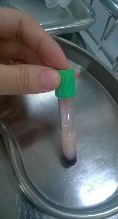 “Choáng” với ống máu xét nghiệm toàn mỡ là chính - 1 Ống máu xét nghiệm của một bệnh nhân tại khoa HSTC chiếm hơn nửa là mỡ.
