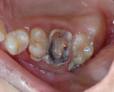 Việt Nam là 1 trong những quốc gia có tỉ lệ bệnh nha chu cao nhất vùng châu Á - Thái Bình Dương - 1 Việt Nam là 1 trong những quốc gia có tỉ lệ bệnh nha chu cao nhất vùng châu Á - Thái Bình Dương - 1