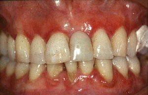 Việt Nam là 1 trong những quốc gia có tỉ lệ bệnh nha chu cao nhất vùng châu Á - Thái Bình Dương - 2 Việt Nam là 1 trong những quốc gia có tỉ lệ bệnh nha chu cao nhất vùng châu Á - Thái Bình Dương - 2