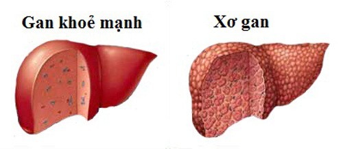 Bia rượu và tổn thương gan: Trả giá vì nuông chiều bản thân - 2