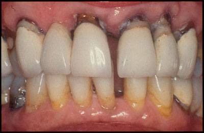 Việt Nam là 1 trong những quốc gia có tỉ lệ bệnh nha chu cao nhất vùng châu Á - Thái Bình Dương - 3 Việt Nam là 1 trong những quốc gia có tỉ lệ bệnh nha chu cao nhất vùng châu Á - Thái Bình Dương - 3