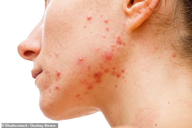 Những dấu hiệu “lạ” mà cơ thể đang cố nói với bạn - 2 Khi bị mụn trứng cá, cơ thể đang cố gắng cảnh báo về rối loạn nội tiết hoặc rối loạn tiêu hóa.
